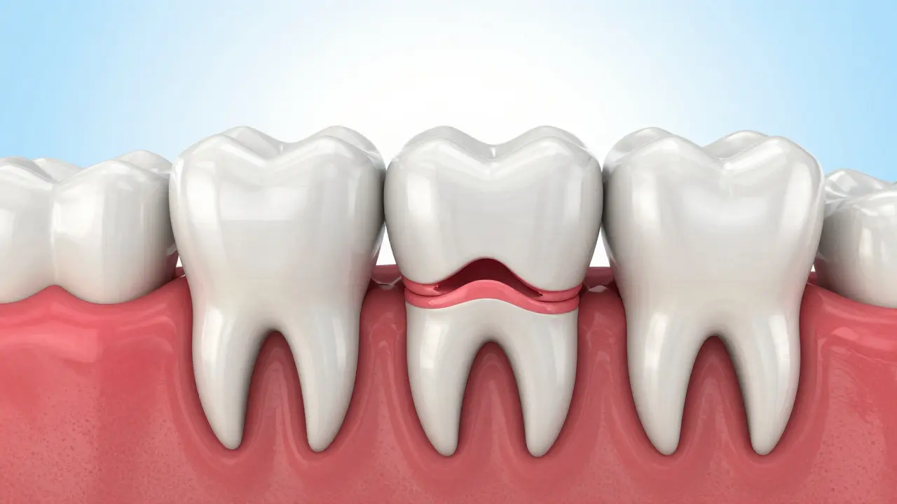 Jak rychle postupuje paradentóza? Průběh, stadia a rizika